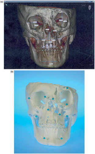 Figure 1. (a) Virtual model rendered by ILUMAVision software and (b) the corresponding SLS model. Individual anatomy is reproduced by SLS technology in detail (e.g., the left paramedian craniofacial cleft). A topographic survey by landmark measurements demonstrated variations between the models of less than 1 mm, which was assessed to be sufficient for surgical use. (c) Measurement of the left anterior orbital height on the virtual and SLS models.