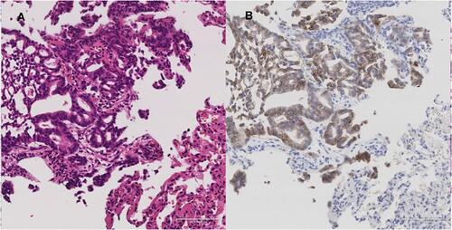 Figure 2 (A) Hematoxylin and eosin staining revealed malignant cells forming glandular duct structures in the transbronchial lung biopsy (TBB) specimen. (B) Malignant cells were strongly positive (3+) for human epidermal growth factor receptor 2 (HER2) based on immunohistochemical staining. Scale bar is 100µm.