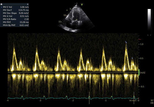 Figure 5. Pulsed wave Doppler showing an E/A ratio >2 suggestive of restrictive mitral inflow velocity