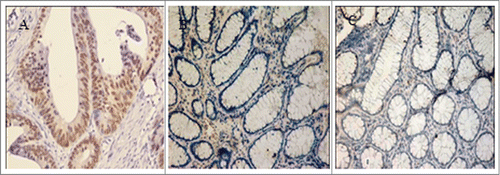 Figure 1. FOXQ1 was overexpressed in colorectal tumor cells. FOXQ1 was stained in colorectal cancer samples (A), adjacent nontumorous tissues (B), and distal normal colorectal mucosa samples (C). Images were acquired at 200X. Representative images are shown.