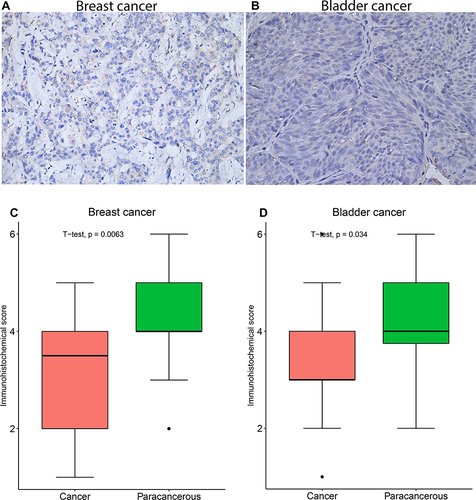 Figure 4 Immunohistochemical staining results and statistical graphs of GIMAP7 protein in breast and bladder cancers. (A and B) The 20× immunohistochemical images of breast cancer and bladder cancer, respectively. (C and D) The statistical results of 20 pairs of breast cancer and bladder cancer tissues, respectively.