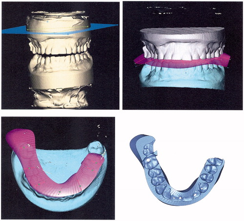 Figure 1. Virtual splint generation. The desired virtual occlusion can be determined after segmentation of scanned dental casts (upper row). A virtual surgical splint can subsequently be designed and datasets can be transformed to .stl files which are required for further computer-assisted manufacturing (lower right).
