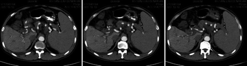 Figure 2 Contrast-enhanced abdominal CT scan with dilatation of portal vein with thrombus and dilatation of splenic vein.