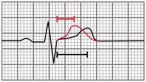 Figure 3. A schematic illustration showing a heartbeat with different JT intervals. The J-point to T peak interval is short in SQTS (red curve, 110 ms) but close to normal in subjects with short-QT interval without the syndrome (black curve, 180 ms).