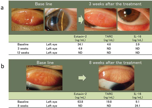 Figure 5. Clinical features of 2 patients with VKC, and the results of the tear cytokine/chemokine test in these patients.a.An 8-year-old girl with VKC. Slit-lamp photographs showing several giant papillae in the upper tarsal conjunctiva and diffuse thickening of the limbal tissue, with trantas spots in both eyes at baseline. These clinical observations improved and tear levels of CCL17/TARC and CCL24/eotaxin-2 decreased after treatment with 2% sodium cromoglycate and 0.1% cyclosporine ophthalmic solution.b.An 8-year-old boy with VKC. Slit-lamp photographs showing several giant papillae in the upper tarsal conjunctiva in both eyes. These clinical observations improved and tear levels of CCL17/TARC and CCL24/eotaxin-2 decreased after treatment with 0.5% tranilast and 0.1% cyclosporine ophthalmic solution. ND: not detected.
