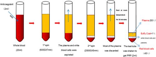 Figure 3 The preparation process of platelet-rich plasma (PRP).
