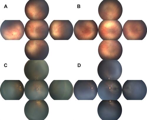 Figure 1 Color fundus photographs of Aggressive Posterior ROP at treatment (A) and at follow-up 1.5 months later (B); Type 1 ROP at treatment (C) and at follow-up 1.5 months later (D).