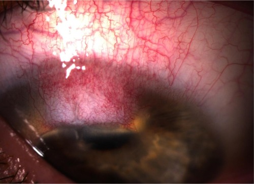 Figure 1 Superior conjunctival hyperemia with pannus.