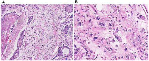 Figure 4 Results of pathological examination. (A) Blue arrow shows invasive ductal carcinoma, while the red arrow shows squamous cell carcinoma. (B) High-grade sarcoma.