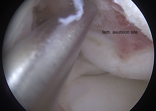 Figure 4 Arthroscopy, notch; femoral avulsion site.