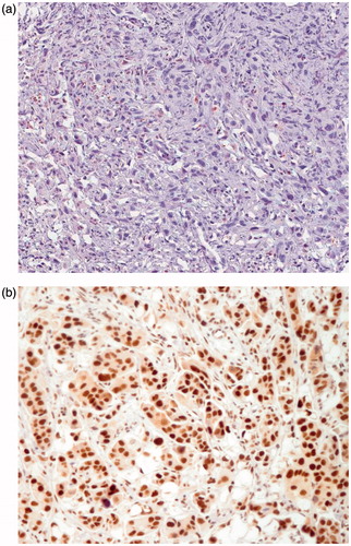 Figure 2. Sample of immunohistochemical images of (a) choline-phosphate cytidylyltransferase-α (CCT-α)-negative and (b) CCT-α-positive expression (20× magnification).