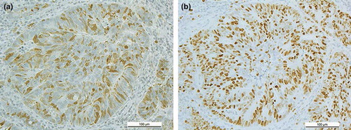 Figure 1. Immunohistochemical staining of securin (a) and Ki-67 (b) in rectal cancer. Staining pattern of Ki-67 was almost exclusively nuclear, while securin had a combination of nuclear and cytoplasmic staining with a clear prominence of nuclear one.