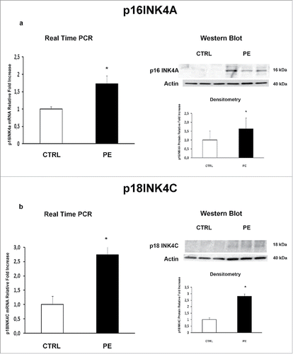 Figure 1. p16INK4A and p18INK4C gene and protein expression in normal vs preeclamptic PDMSCs. (a) mRNA (left panel) and protein (right panel) expression of p16INK4A in normal (N, n = 20) and PE-PDMSCs (PE, n = 24) (b) mRNA (left panel) and protein (right panel) expression of p18INK4C in normal (N, n = 20) and PE-PDMSCs (PE, n = 24). Statistical significance (*) has been considered as p < 0.05.