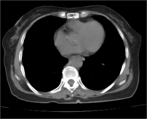 Figure 5 A follow-up chest computed tomography image 2 months after surgery showing resolution of the bilateral pleural effusion.