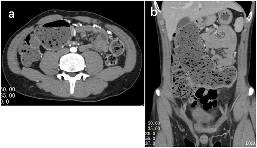 Figure 5 (a and b) Abdominal CT ascending colon, transverse colon, and part of the descending colon showing dilatation and fluid accumulation (most dilated at 5.2 cm).