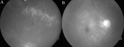 FIGURE 1  (A) Fundus photo showing superior cytomegalovirus (CMV) retinitis characterized by yellowish necrotic retinitis along blood vessels with adjacent flame hemorrhage and vasculitis. (B) Fundus photo of posterior pole with drusen but no retinitis and minimal vitritis.