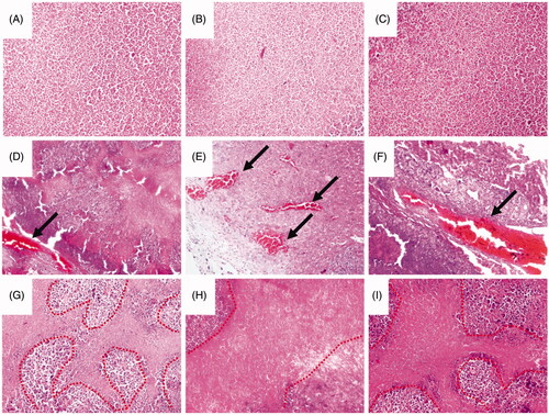 Figure 8. Histology studies of the treatment effect of the magnetic procoagulant protein in subcutaneous transplantation tumour models. (A ∼ C) Representative picture of the cancer tissue after treatment of controls groups (saline (A), OCMC/Fe3O4 (B) and tTF-EG3287 (C)) stained with haematoxylin and eosin. Obvious thrombus (D ∼ F) and necrotic area (G ∼ I) were found in the blood vessels of hepatic carcinoma after treated by the MTPCP tTF-EG3287@OCMC/Fe3O4 for 4 consecutive days.