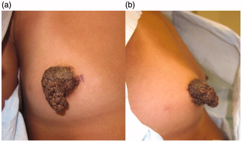 Figure 1. Angiofibroma right NAC. (a) Anterior view of the mass. (b) Lateral view of the mass.