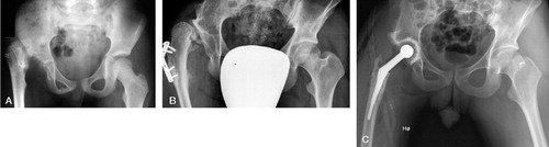 Figure 4. Patient no 4. A. Preoperatively, showing a luxated hip without any signs of a femoral head. Note the severe dysplasia of the acetabulum. B. 15 years after operation, showing that the new femoral head, which is nearly spherical, is poorly covered by a neoacetabulum above a severely dysplastic acetabulum. Osteoarthritis has developed. C. After insertion of a total hip prosthesis.