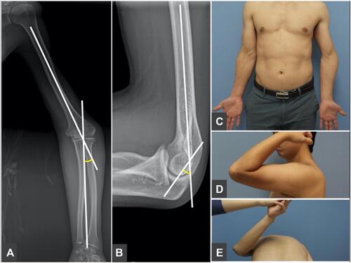 Figure 3 In radiographic measurements, the humerus-elbow-wrist angle (A) comprised the angle between the humeral axis and a line passing through the proximal and distal midpoints of the radius and ulna. The tilting angle (B) was determined by the anterior tilt of the articular condyles with respect to the humeral axis on a lateral radiograph. For physical measurements, the carrying angle (C), elbow flexion (D), and shoulder internal rotation (E) were estimated.