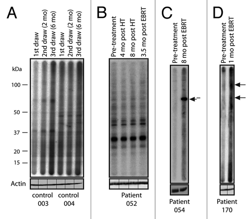 Figure 1. Treatment-associated responses to prostate tumor antigens. Western blot analysis of serum from 2 healthy donor controls and 3 patients with prostate cancer probed against LNCaP cell lysate. The timing of sample collection for each patient is indicated. New seroreactivities are indicated with arrows. (A) Two healthy donor controls showing no seroreactivity. (B) Patient 052, who did not develop an autoantibody response throughout treatment. (C) Patient 054, who was treated with androgen-deprivation therapy (ADT) plus external beam radiation therapy (EBRT) and developed a new response 8 mo post-EBRT. (D) Patient 170, who developed two new responses 1 mo post-EBRT. Each blot was re-probed with actin without the multichannel device to ensure equal protein loading across each lane. The lines indicate the original slot-blot lane for each sample.