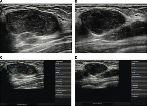 Figure 6 The breast lesion of a 41-year-old woman with a history of invasive phyllodes tumor.Note: (A) The longitudinal section of the lesion; (B) the cross-section of the lesion; and (C, D) the lesion was misdiagnosed by S-detect as a possibly benign tumor.