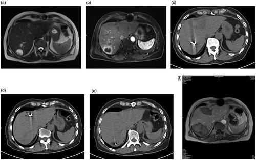 Figure 1. (a) A 63-year-old male CRLM patient with the primary tumor origin in the colon. The patient did not have extrahepatic metastases and was assigned to the patient group with curative clinical indication. T2-weighted (a) and T1-weighted contrast-enhanced (b) MRI images before MWA show three hepatic metastases in segments 4a, and 7. CT images (c, d and e) show the position of the Antenna during the ablation procedure. Follow-up T1-weighted contrast-enhanced MRI at six months (f) show complete ablation and no recurrence at the site of ablation.