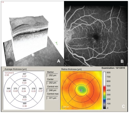 Figure 2 Spectral domain optical coherence tomography (A), fluorescein angiogram (B), and spectral domain optical coherence tomography thickness map (C) of the left eye after treatment with difluprednate.