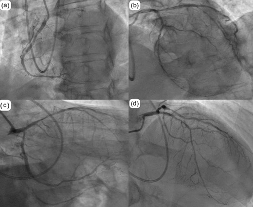Figure 1. Coronary angiogram showing (a) LAO view of right coronary artery revealing ostial right posterior descending artery stenosis (b) LAO cranial view of left coronary artery demonstrating distal left main disease (c) RAO caudal view showing ostial left circumflex disease and (d) RAO cranial view showing diffusely calcified proximal-mid left anterior descending artery disease