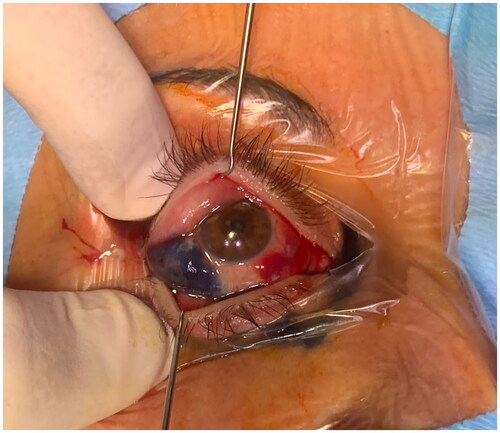 Figure 5. Intraoperative aspect of methylene blue demarcation of the chemotic area at right eye before snip conjunctivoplasty.