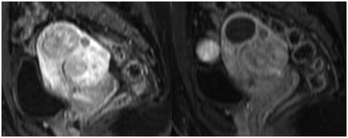 Figure 1. Sagittal MRI of fibroid at baseline (craniocaudal measurement 34.7 mm) and at 6 months post treatment (26.7 mm).