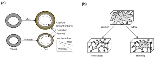 Figure 1 Gender differences in pattern of cortical (a) and trabecular (b) bone loss resulting in trabecular and cortical thinning in men and increased cortical porosity and trabecular perforation in women. Reproduced with permission from CitationSeeman E. 2002. Pathogenesis of bone fragility in women and men. Lancet, 359:1841–50. Copyright © 2002 Elsevier.