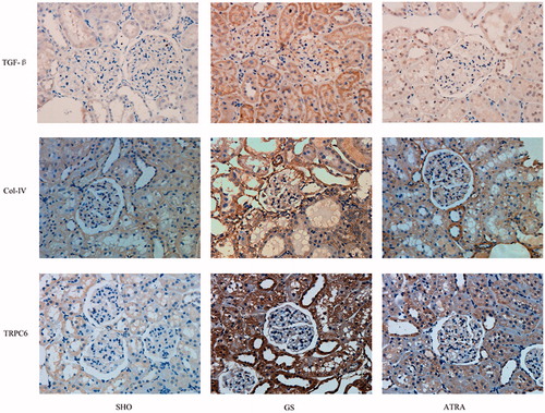 Figure 3. The typical immunohistochemical staining of TGF-β, Col-IV and TRPC6 in glomerulus in three groups. Stainings for TGF-β, Col-IV, and TRPC6 in the GS group were markedly increased when compared with those in the SHO group. The positive stainings of TGF-β, Col-IV, and TRPC6 in the ATRA group were markedly reduced when compared with the GS group. SHO: sham operation group; GS: GS model group; ATRA: GS model group treated with ATRA. Magnification 400×.