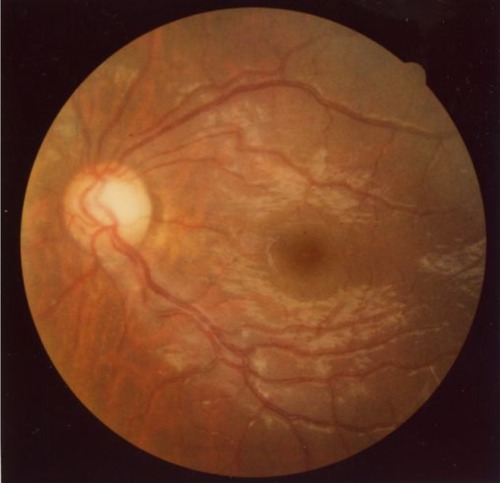 Figure 2 Color fundus photograph of the patient’s left eye, obtained prior to cataract surgery.