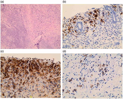 Figure 1. Unspecified low-grade B-cell lymphoma with features of IgG4-related disease in the resected submandibular gland. (a) Abundant infiltration by small lymphocytic and plasma cells, and features of storiform fibrosis (hematoxylin and eosin staining, magnification ×100). (b) IgG4+ plasma cells located in the periphery of the lymphoma tissue (magnification ×400). (c) IgG + plasma cells (magnification ×400). (d) CD138+ plasma cells (magnification ×400).