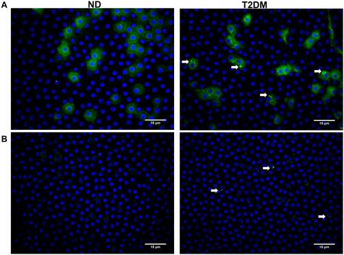 Figure 2 Immunohistochemistry (40x) in ND and T2DM samples using Con A-FITC (green) and DAPI as nuclear counterstain. (A) Con A membrane and cytoplasmic labeling is evident in both ND and T2DM samples; T2DM samples additionally show perinuclear vesicles (white arrows) that, (B) after trypsin treatment during 6 hours at 37°C, show a certain degree of resistance to digestion.