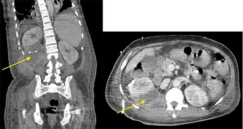 Figure 1. CT of abdomen and pelvis with intravenous contrast revealing right-sided PA with multiloculation and contiguous spread, as shown by the arrows in the coronal (left) and sagittal (right) sections.