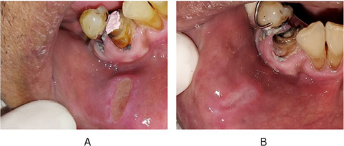 Figure 3 (a) Single ulcer with a yellowish base surrounded by erythematous areas, oval, well-defined margins with induration and pain; (b) lesion improved at about 3 weeks of therapy.