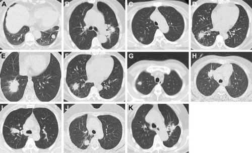 Figure 1 The computed tomography morphological features of patients with stage I non-small cell lung cancer.