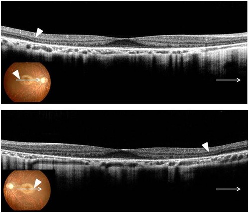 Figure 2 Right and left horizontal optical coherence tomography scan showed decreased retinal thickness.