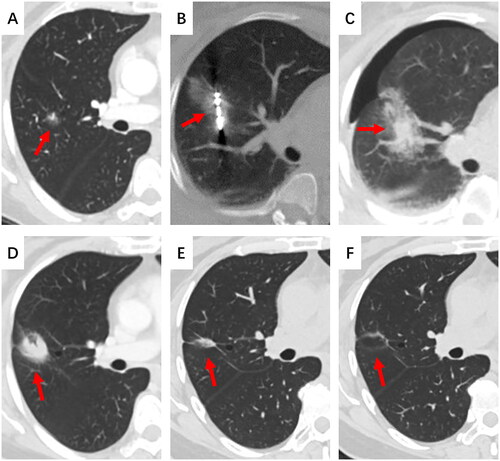 Figure 2. A female, 55-year-old patient with GGN-like lung cancer in the RML underwent MWA. (A) A mixed GGN located in the RML with a diameter of 12 mm. (B) An antenna was inserted into the tumor. (C) The lesion was covered by ground-glass opacity, and a small amount of pneumothorax was observed immediately post-ablation. (D) The lesion involuted at 1-month post-ablation. (E) The lesion gradually involuted at 12-months post-ablation. (F) The lesion involuted into a band at 36-months post-ablation.