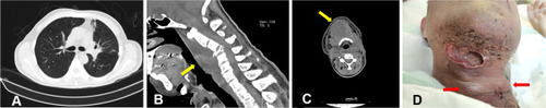 Figure 3 Computed tomography findings. Chest: The pulmonary lesions were markedly improved after 3 weeks of antifungal therapy (A). Neck: An abscess in the posterior pharyngeal wall, a fracture of the 4th cervical vertebra (B), and new mass on the right side of the neck (C) were found. The abscess disseminated to the lower right neck and sternum (D).