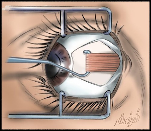 Figure 1 Limbal conjunctival incision and isolation of medial rectus muscle; the tendon width must be 8 mm or more. Courtesy of Dr Sherif El Far.
