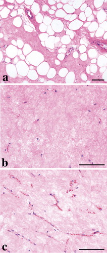 Figure 3. Irradiated MLS/RCLS with lipogenic maturation with mostly univacuolated adipocyte-like cells, (10x) (a), hyalinisation and pausicelluarity, (20x) (b) and preserved delicate capillary network, (20x) (c). Bar denote 100 micrometres.