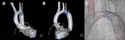 Figure 3. Hybrid imaging during stent placement in a coarctation of the aorta. (A,B) 3D reconstruction of the left ventricle and aorta (white structure) and stent in the aortic arch (blue structure), respectively shown in the AP and LAO projections. (C) 3D overlay of the aortic arch with the stent in place. The 3D roadmap is used to provide targeted stent placement and avoid obstruction of the left common carotid and left subclavian arteries