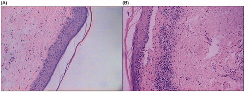 Figure 2. Pathological features of LS before and after HIFU treatment. (A) LS before treatment, squamous epithelium is thin, epithelial ridge becomes blunt or disappeared; cornification appears in epidermis, the superficial layer of dermis develops oedema, and fibrous tissue shows hyperplasia and glassy degeneration. (B) LS after treatment, the epithelium is thickened, epithelial ridges become obvious, and number of inflammatory infiltrated cells has decreased. HE (hematoxylin-eosin staining) 100 × diseased tissues.