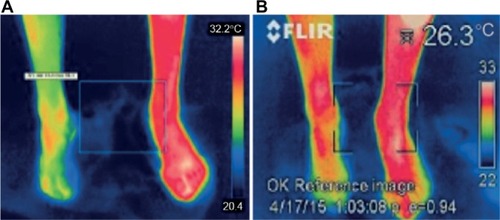 Figure 6 Thermographic effect of stimulation of the right leg in patient 5 demonstrated on the controlled visit after 1 month.