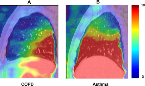 Figure 6 Typical movement of the lung. The amount of local lung movement was quantified and displayed as “displacement map”. The local lung movement in COPD patients were significantly smaller than those in asthma patients especially in the ventral part of the lung. Color wash range: displacement: 0–10. (A) A typical movement of COPD. (B) A typical movement of asthma.
