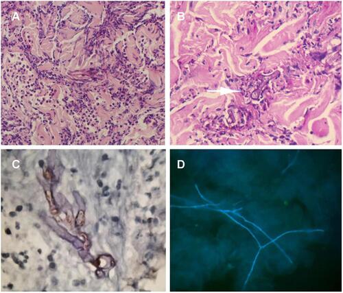 Figure 2 (A) Broad non-septate hypha were found in the dermis in hematoxylin eosin staining. (B) Broad non-septate hypha were found in the dermis in periodic acid schiff staining. (C) Immunohistochemical staining with M.oryzae antibody was positive. (D) The KOH examination of the crust on the ulcer showed thin septate hypha.