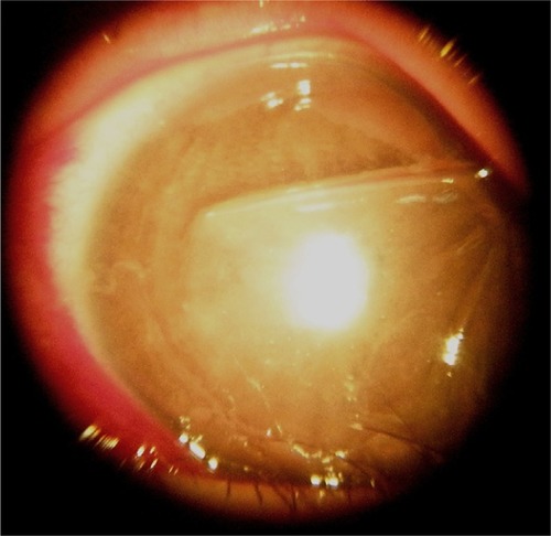 Figure 1 A late-onset corneal flap displacement with superior and inferior portion of flap being folded is shown. Bare stroma is exposed and intact nasal hinge is visible under surgical microscope.